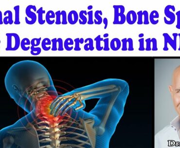 Best Strategies for Cervical (Neck) Spinal Stenosis, Disc Degeneration, Bone Spurs - Dr Mandell, DC