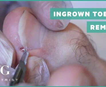 Ingrown Toenail removal treatment (Left foot)