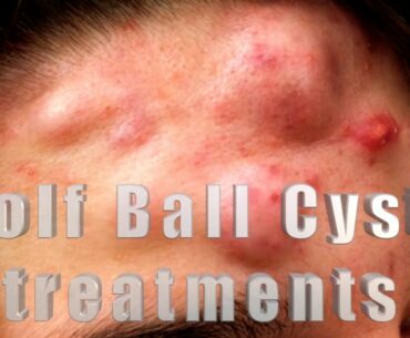 How to treat huge acne cysts the size of golf balls!