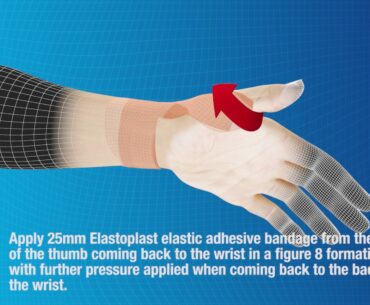 Elastoplast: How to strap and support the thumb