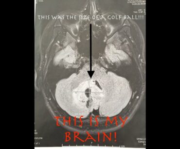 I had a Brain Tumor the size of a GOLF BALL!