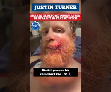 ⚠️😵 Justin Turner GRUESOME injury hit in face by pitch knocked to ground, COMEBACK recovery‼️🙏 💪