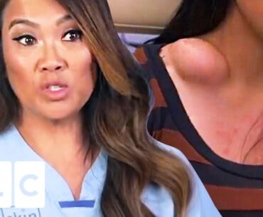 The Contents Of This Huge Bump Surprises Dr Lee | Dr. Pimple Popper