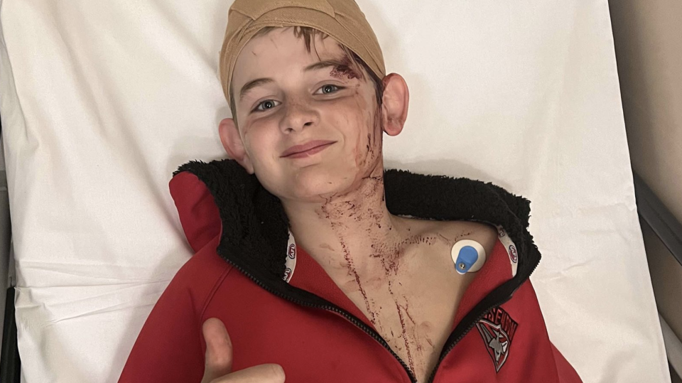 Phoenix Doherty, 12, with blood on his head and chest after being attacked by a large male kangaroo on the edge of his property in Victoria. 